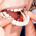 Съемные виниры для зубов Snap On Smile на 2 челюсти • Накладные виниры на верхнюю и нижнюю челюсть для красивой улыбки